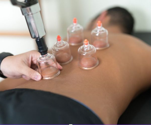 cupping therapy